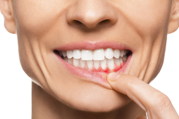 Treating Gum Disease If You Have Gingivitis